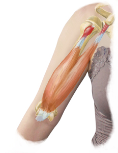 Bicep Tendonitis Treatment